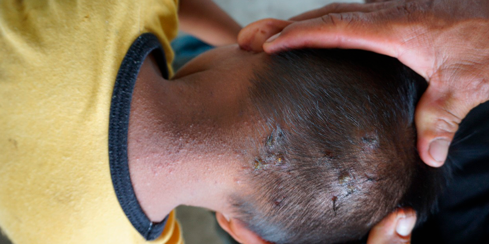 Niña kichwa con afectaciones cutáneas debido a contaminación por derrame de crudo. Foto: Cortesía de Amazon Frontlines