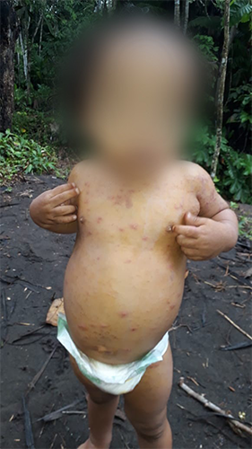 Bebé de la Comuna Domingo Playa con afecciones en la piel por derrame de crudo. Foto: Alianza por los Derechos Humanos